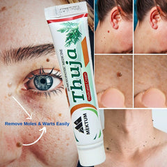 Warts and Moles Removal Treatment Cream Crazy Things