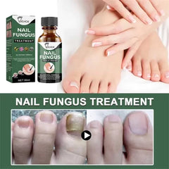 Nail Fungus Removal Serum Crazy Things