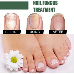 Nail Fungus Removal Serum Crazy Things