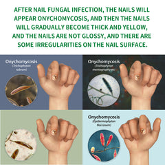 Nail Fungus Removal Serum Crazy Things