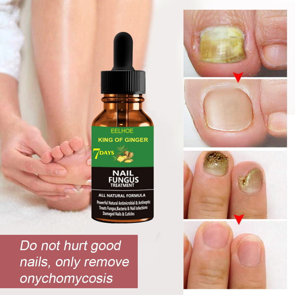 Nail Fungus Removal Serum Crazy Things